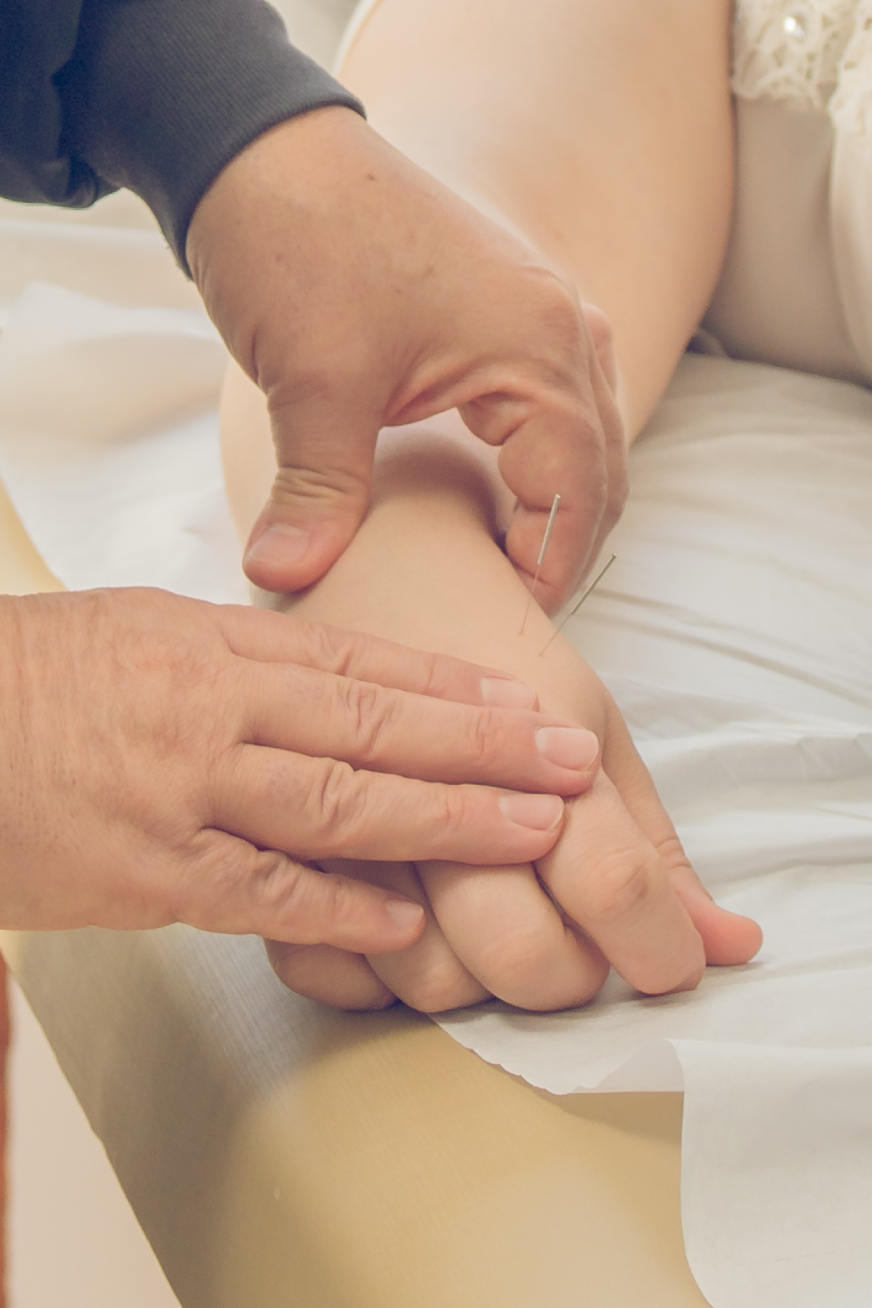 Paciente recebendo tratamento de acupuntura