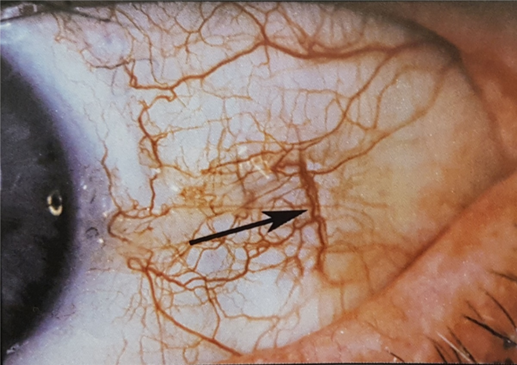 Exemplo de íris com veias paralelas grossas